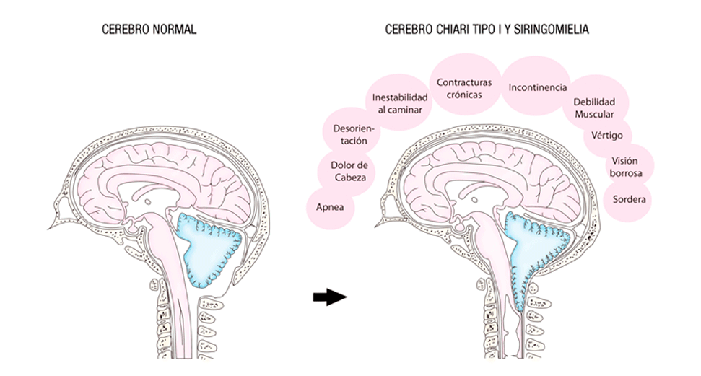 cerebro normal vs cerebro con Chiari de tipo I y Siringomielia