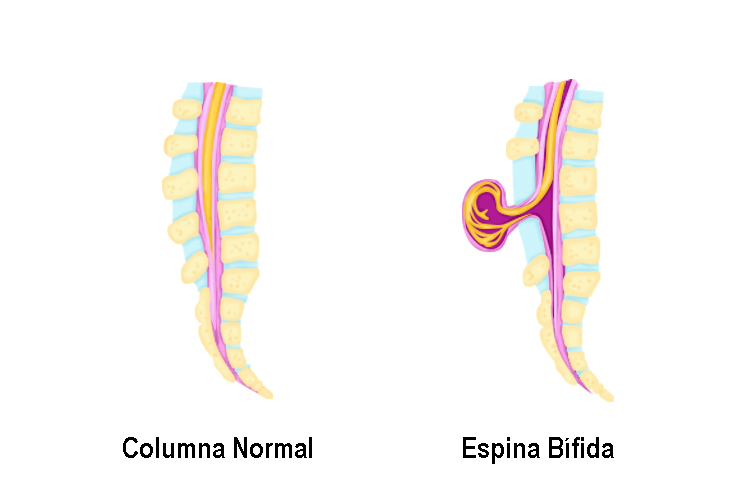 espina bifida
